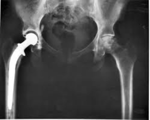 Hip Replacement Surgery Pune