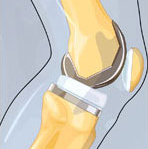 Joint replacement